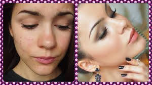 6 Tips on How to Clear up Acne